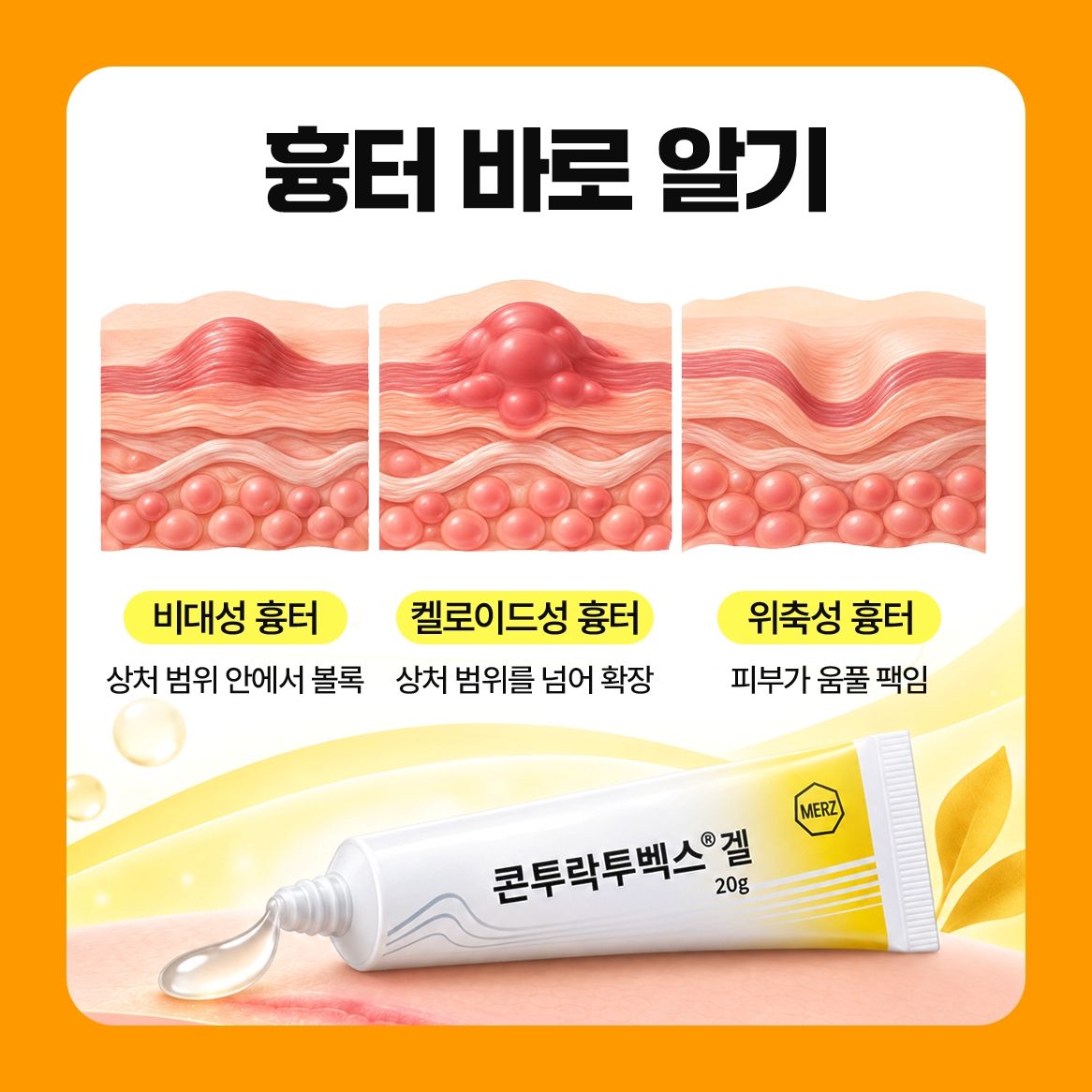 흉터 치료 연고, 흉터 모양 구분과 특징 안내 콘투락투벡스